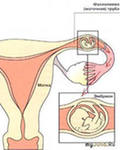 Внематочная беременность